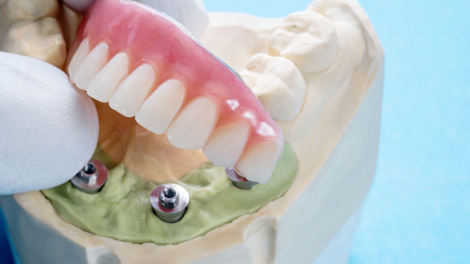 implant-supported dentures, traditional dentures, denture stability, chewing efficiency dentures, denture comfort comparison, implant dentures vs traditional, denture eating comfort, stabilized dentures benefits, full mouth dentures, dental implant supported dentures