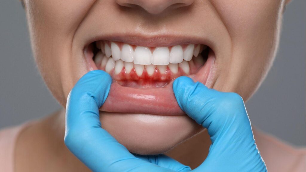 implant dentistry gum disease, dental implants after gum disease, gum disease patient implants, safe implant strategies gum issues, predictable implant outcomes gum disease, gum disease dental implant treatment, implant solutions for gum disease, gum disease and implant success, preventive implant dentistry gum health, gum disease supportive implant care
